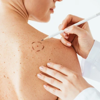 Melanomul – poate fi prevenit cel mai agresiv cancer de piele?