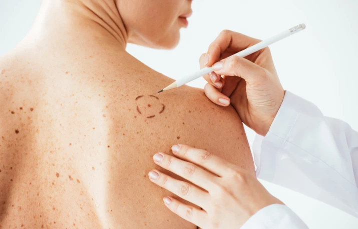 Melanomul – poate fi prevenit cel mai agresiv cancer de piele?