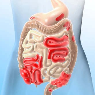 Calprotectina - Analiza care indică inflamația intestinală