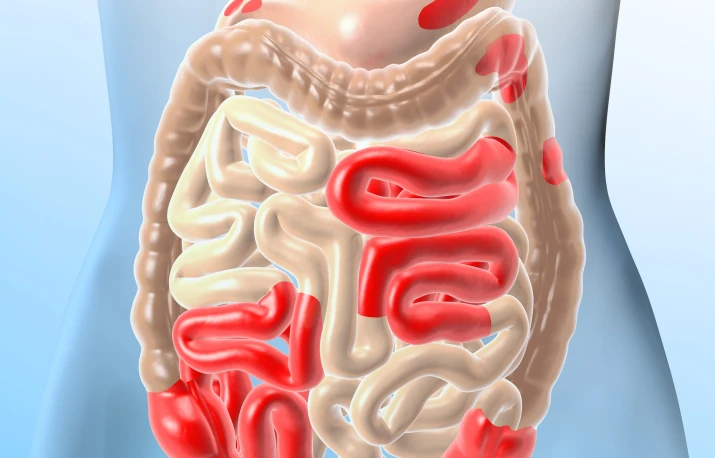 Calprotectina - Analiza care indică inflamația intestinală