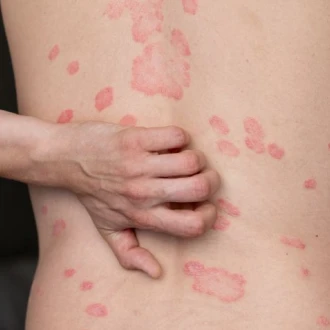 Psoriazis – cauze, simptome, tratament și managementul bolii