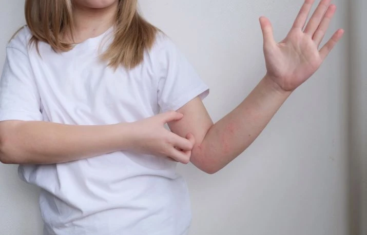 Dermatita atopică și intestinul – există o legătură?