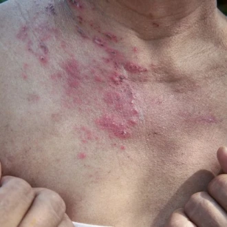 Dermatomiozita – cauze, simptome și tratament