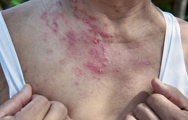 Dermatomiozita – cauze, simptome și tratament