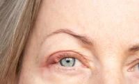 5 soluții rapide pentru ulcior la ochi, pe care le poți încerca acasă
