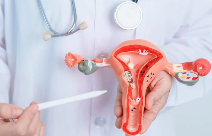 ENDOMETRIOZA – noi soluții de diagnostic și tratament