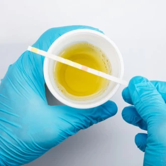 Uree crescută? 7 pași simpli pentru echilibrarea valorilor la analize