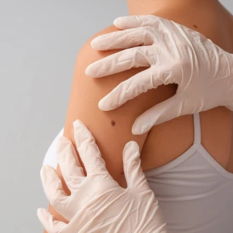 Cancerul de piele – depistare precoce și prevenție