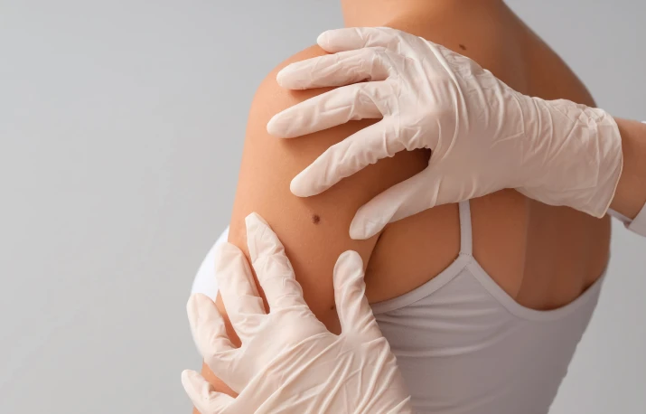 Cancerul de piele – depistare precoce și prevenție