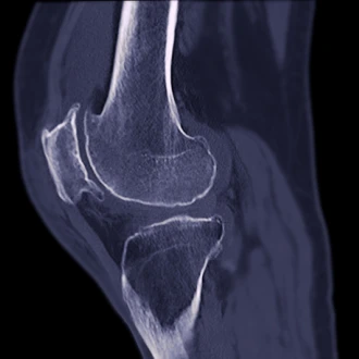 Osteodensitometria (DEXA) – când se recomandă testul pentru osteoporoză
