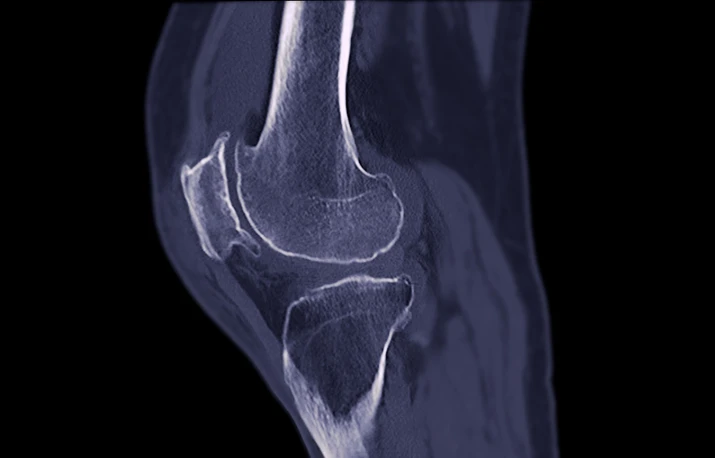 Osteodensitometria (DEXA) – când se recomandă testul pentru osteoporoză