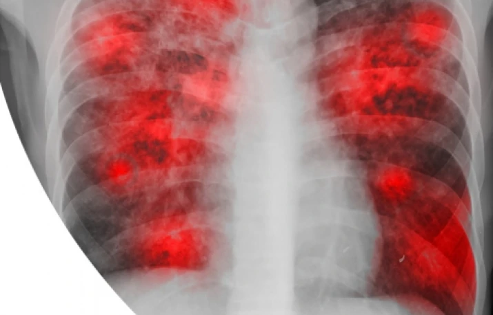 Tuberculoza – flagelul care ameninţă din nou lumea