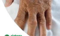 Guta la articulațiile degetelor de la mână