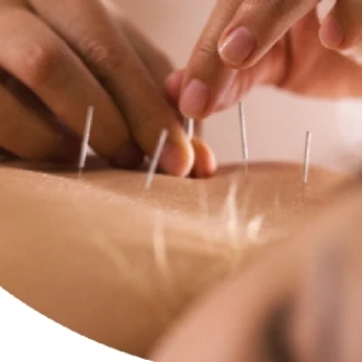 Acupunctura – pregatire pentru nastere 