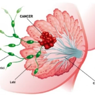 Cancerul de sân apare la vârste din ce în ce mai tinere
