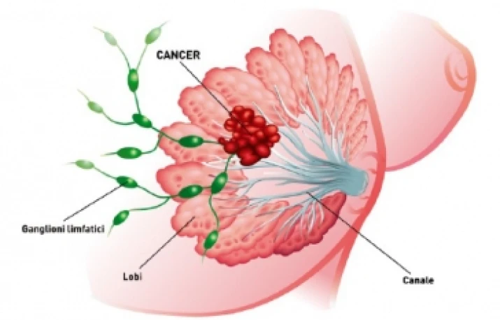 Cancerul de sân apare la vârste din ce în ce mai tinere